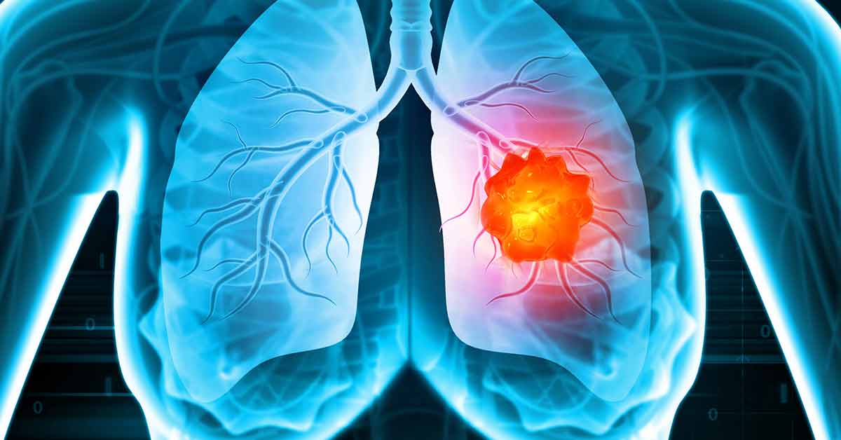 Lung Cancer Rendering