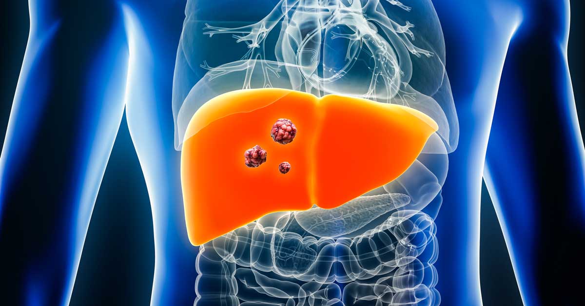 Liver Cancer Rendering