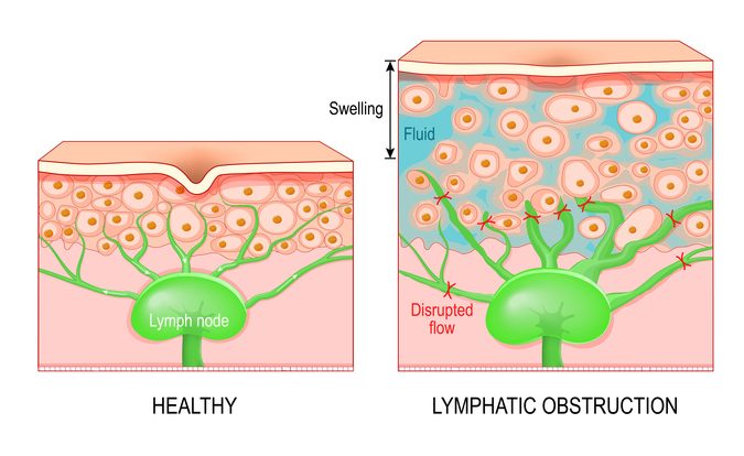 Lymphedema. Cross section of a human skin stock illustration