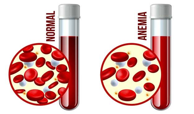 Anemia infographic